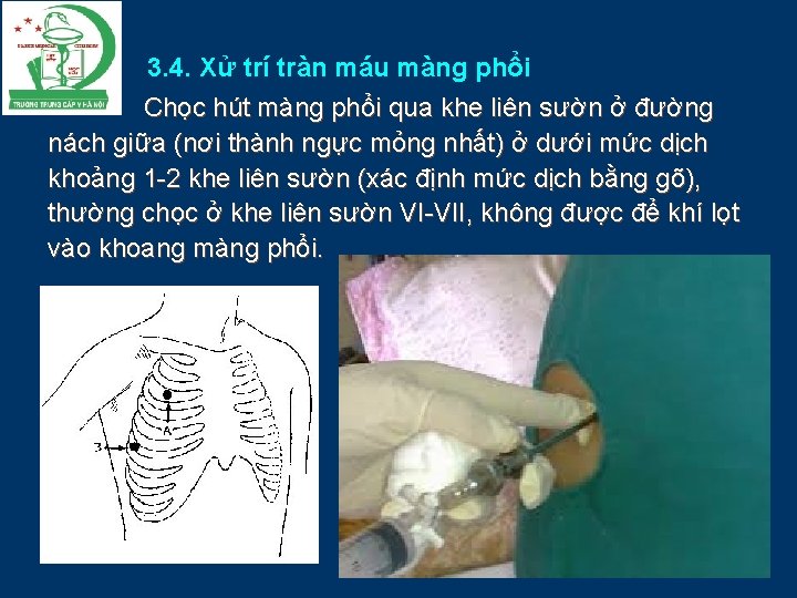 3. 4. Xử trí tràn máu màng phổi Chọc hút màng phổi qua khe