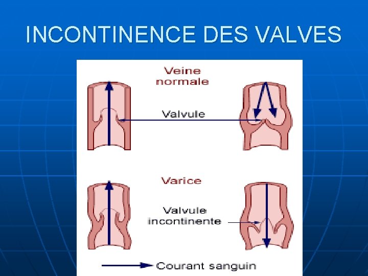 INCONTINENCE DES VALVES 