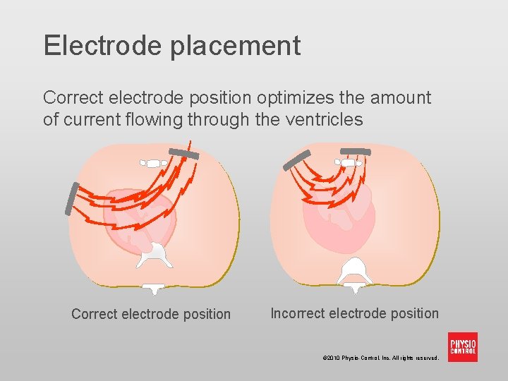 Electrode placement Correct electrode position optimizes the amount of current flowing through the ventricles