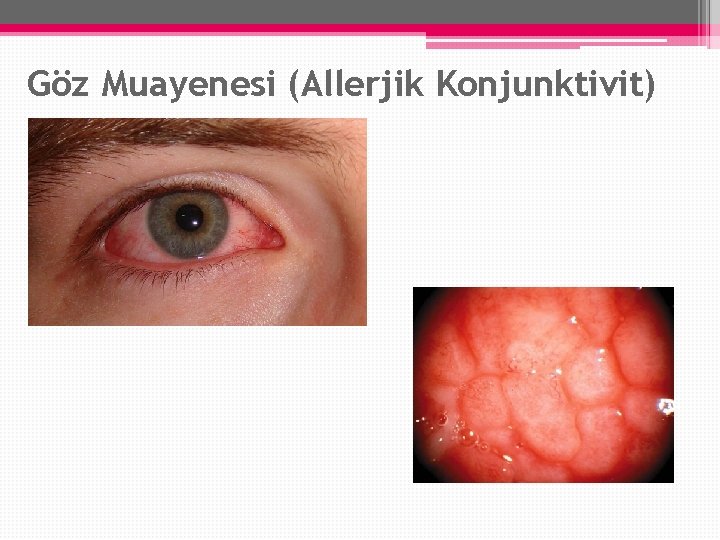 Göz Muayenesi (Allerjik Konjunktivit) Göz Muayenesi (Allerjik Konjunktivit)