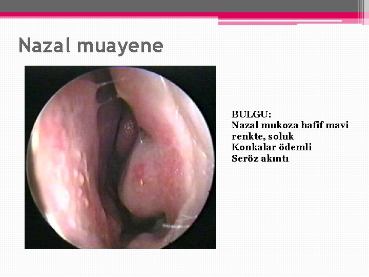 Nazal muayene BULGU: Nazal mukoza hafif mavi renkte, soluk Konkalar ödemli Seröz akıntı 