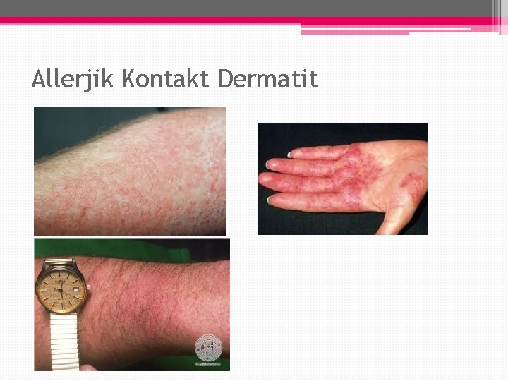 Allerjik Kontakt Dermatit Allerjik Kontakt Dermatit