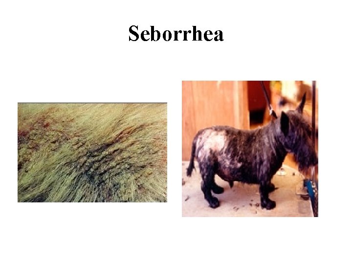 Seborrhea 