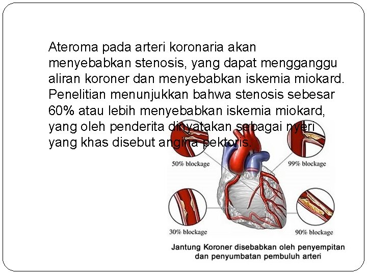 Ateroma pada arteri koronaria akan menyebabkan stenosis, yang dapat mengganggu aliran koroner dan menyebabkan