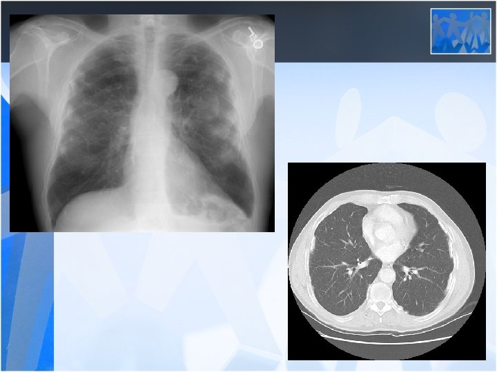 pleural biopsy for mesothelioma