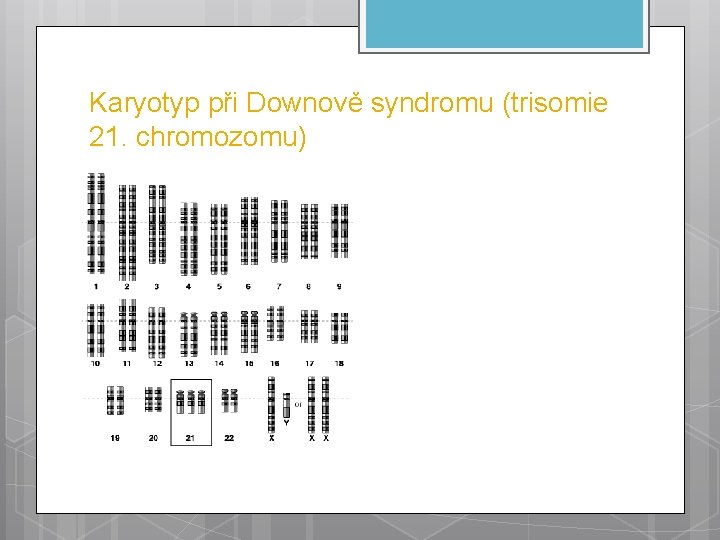 Karyotyp při Downově syndromu (trisomie 21. chromozomu) 
