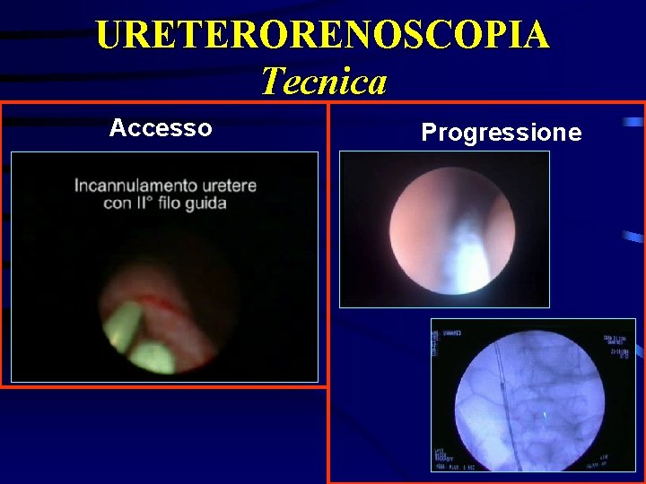 URETERORENOSCOPIA Tecnica Accesso Progressione 