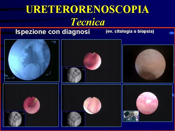 URETERORENOSCOPIA Tecnica Ispezione con diagnosi (ev. citologia o biopsia) 