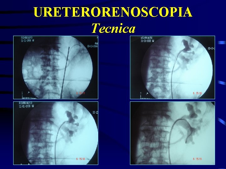 URETERORENOSCOPIA Tecnica 
