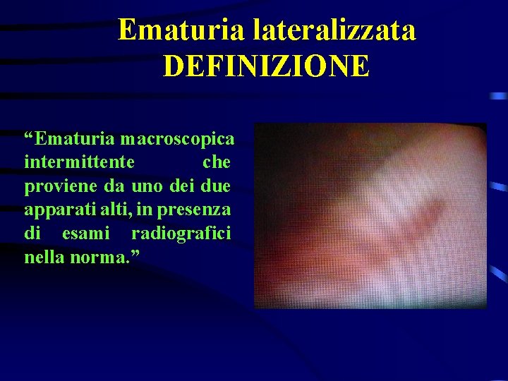 Ematuria lateralizzata DEFINIZIONE “Ematuria macroscopica intermittente che proviene da uno dei due apparati alti,