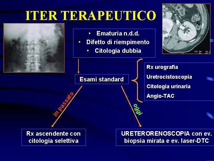 ITER TERAPEUTICO • Ematuria n. d. d. • Difetto di riempimento • Citologia dubbia
