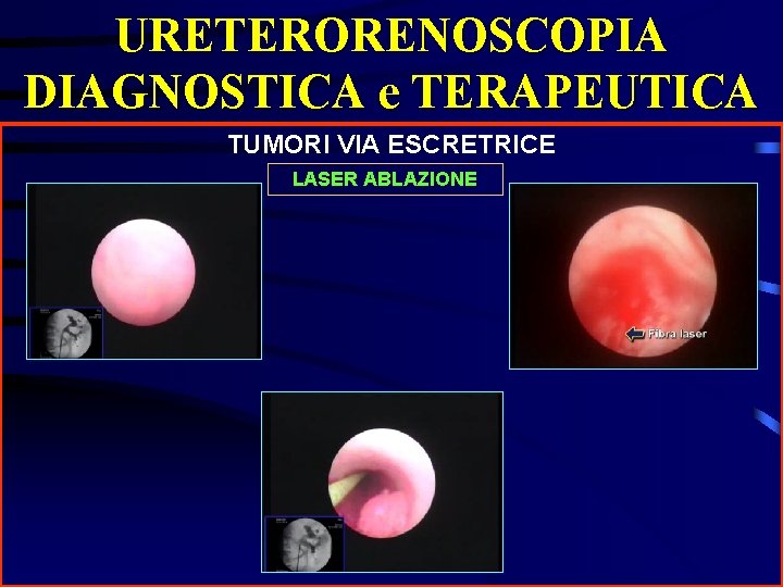URETERORENOSCOPIA DIAGNOSTICA e TERAPEUTICA TUMORI VIA ESCRETRICE LASER ABLAZIONE 