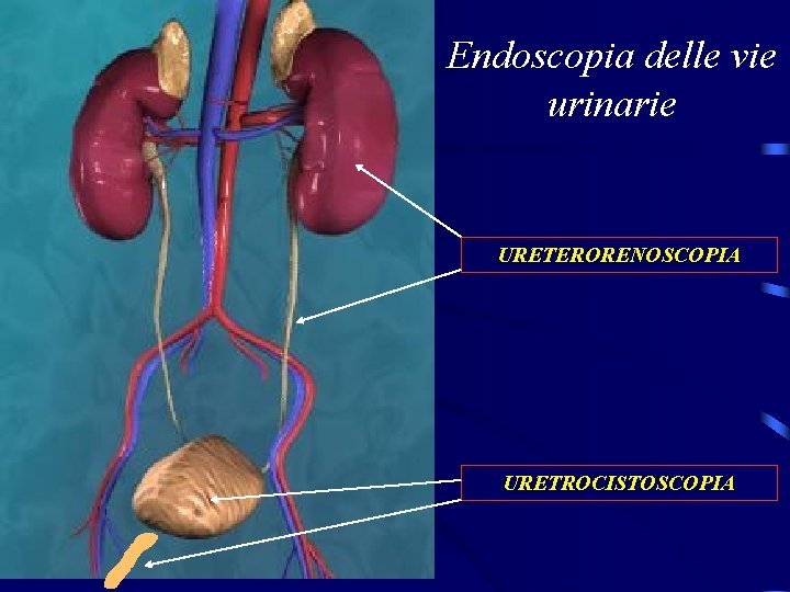 Endoscopia delle vie urinarie URETERORENOSCOPIA URETROCISTOSCOPIA 