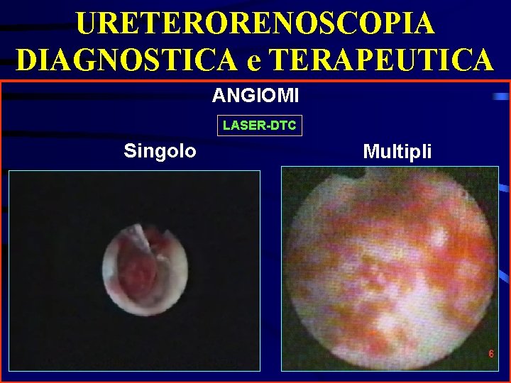 URETERORENOSCOPIA DIAGNOSTICA e TERAPEUTICA ANGIOMI LASER-DTC Singolo Multipli 