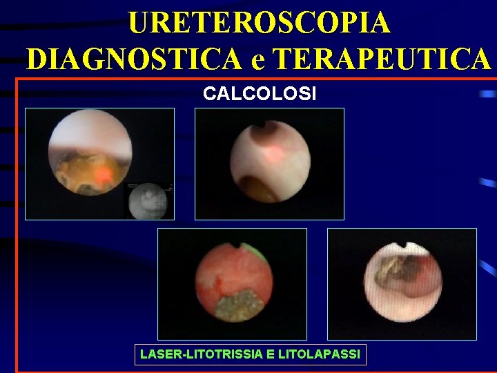 URETEROSCOPIA DIAGNOSTICA e TERAPEUTICA CALCOLOSI LASER-LITOTRISSIA E LITOLAPASSI 