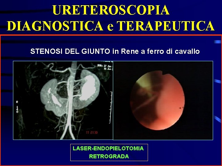 URETEROSCOPIA DIAGNOSTICA e TERAPEUTICA STENOSI DEL GIUNTO in Rene a ferro di cavallo LASER-ENDOPIELOTOMIA
