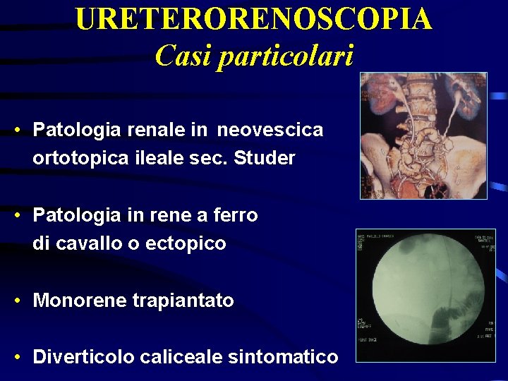 URETERORENOSCOPIA Casi particolari • Patologia renale in neovescica ortotopica ileale sec. Studer • Patologia