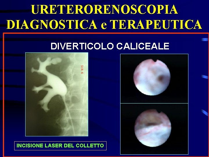 URETERORENOSCOPIA DIAGNOSTICA e TERAPEUTICA DIVERTICOLO CALICEALE INCISIONE LASER DEL COLLETTO 