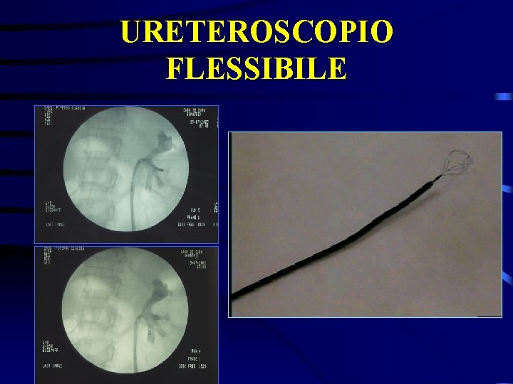 URETEROSCOPIO FLESSIBILE 