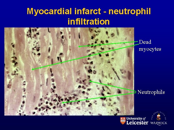 Myocardial infarct - neutrophil infiltration Dead myocytes Neutrophils 