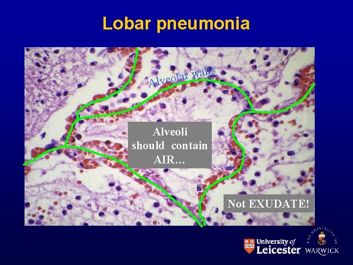Lobar pneumonia ls l a w r lveola A Alveoli should contain AIR… Not