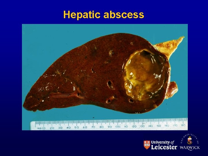 Hepatic abscess 