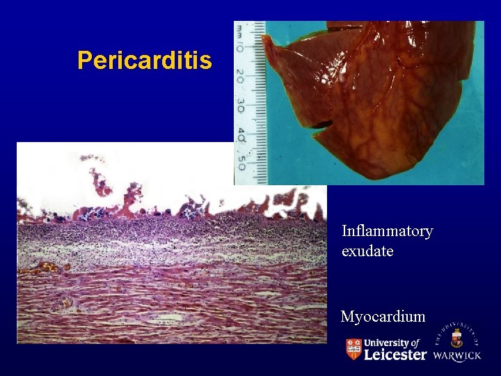 Pericarditis Inflammatory exudate Myocardium 