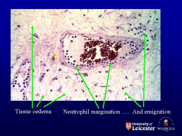 Tissue oedema Neutrophil margination …. And emigration 