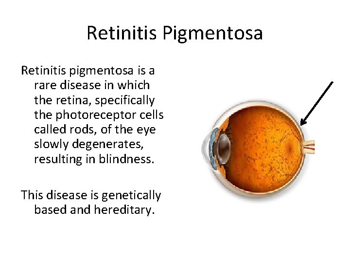 Retinitis Pigmentosa Retinitis pigmentosa is a rare disease in which the retina, specifically the Retinitis Pigmentosa Retinitis pigmentosa is a rare disease in which the retina, specifically the