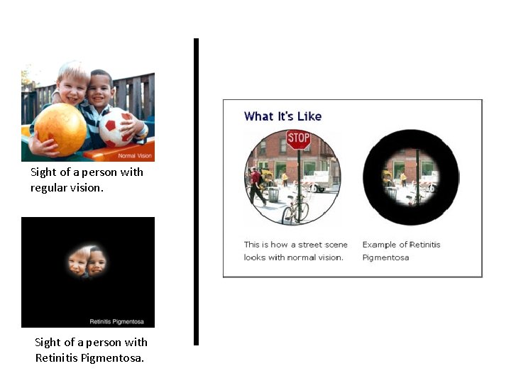 Sight of a person with regular vision. Sight of a person with Retinitis Pigmentosa. Sight of a person with regular vision. Sight of a person with Retinitis Pigmentosa.
