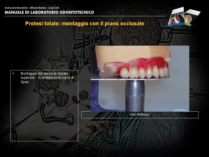 Protesi totale: montaggio con il piano occlusale • Montaggio del secondo molare superiore. Si