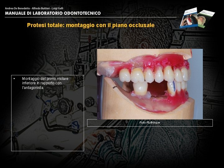 Protesi totale: montaggio con il piano occlusale • Montaggio del primo molare inferiore in