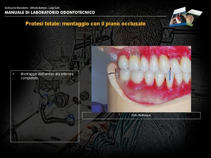 Protesi totale: montaggio con il piano occlusale • Montaggio dell’emiarcata inferiore completato. Foto Ruthinium
