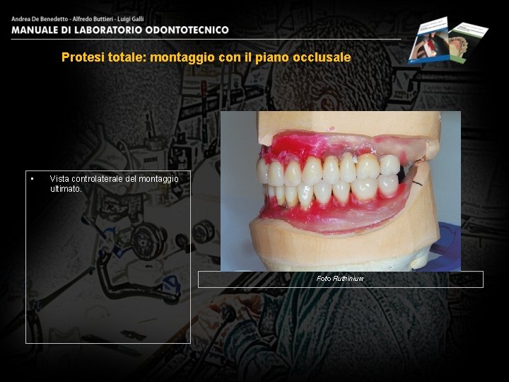 Protesi totale: montaggio con il piano occlusale • Vista controlaterale del montaggio ultimato. Foto