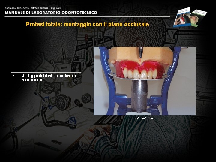 Protesi totale: montaggio con il piano occlusale • Montaggio dei denti dell’emiarcata controlaterale. Foto