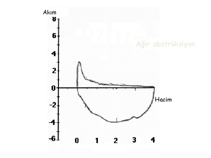 Akım Ağır obstrüksiyon Hacim 