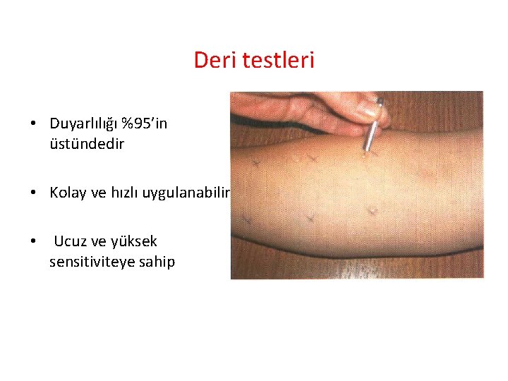 Deri testleri • Duyarlılığı %95’in üstündedir • Kolay ve hızlı uygulanabilir • Ucuz ve