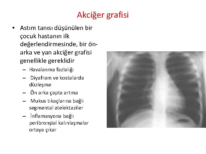 Akciğer grafisi • Astım tanısı düşünülen bir çocuk hastanın ilk değerlendirmesinde, bir ön arka