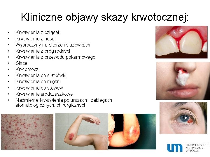 Kliniczne objawy skazy krwotocznej: • • • Krwawienia z dziąseł Krwawienia z nosa Wybroczyny