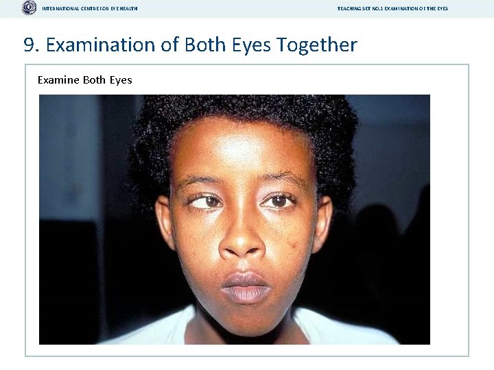 INTERNATIONAL CENTRE FOR EYE HEALTH TEACHING SET NO. 1 EXAMINATION OF THE EYES 9.