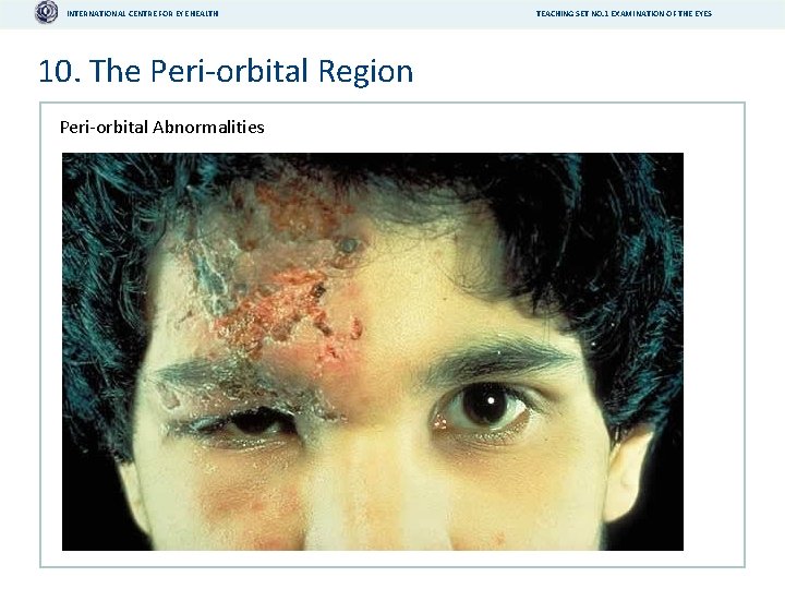 INTERNATIONAL CENTRE FOR EYE HEALTH 10. The Peri-orbital Region Peri-orbital Abnormalities TEACHING SET NO.