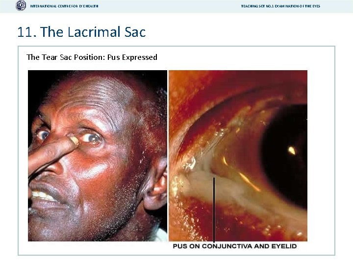 INTERNATIONAL CENTRE FOR EYE HEALTH 11. The Lacrimal Sac The Tear Sac Position: Pus