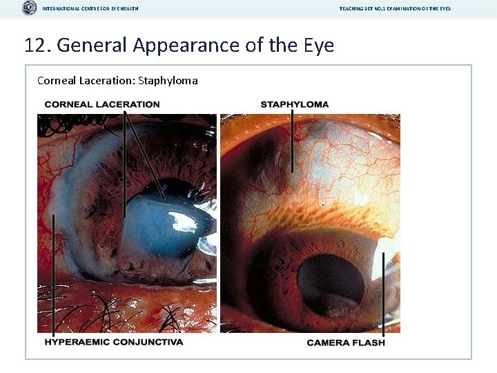 INTERNATIONAL CENTRE FOR EYE HEALTH 12. General Appearance of the Eye Corneal Laceration: Staphyloma