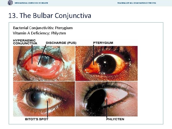 INTERNATIONAL CENTRE FOR EYE HEALTH 13. The Bulbar Conjunctiva Bacterial Conjunctivitis: Pterygium Vitamin A