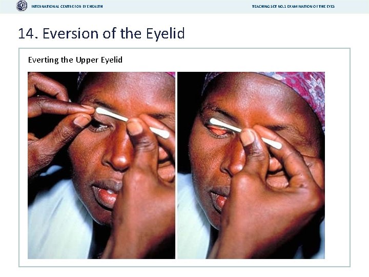 INTERNATIONAL CENTRE FOR EYE HEALTH 14. Eversion of the Eyelid Everting the Upper Eyelid