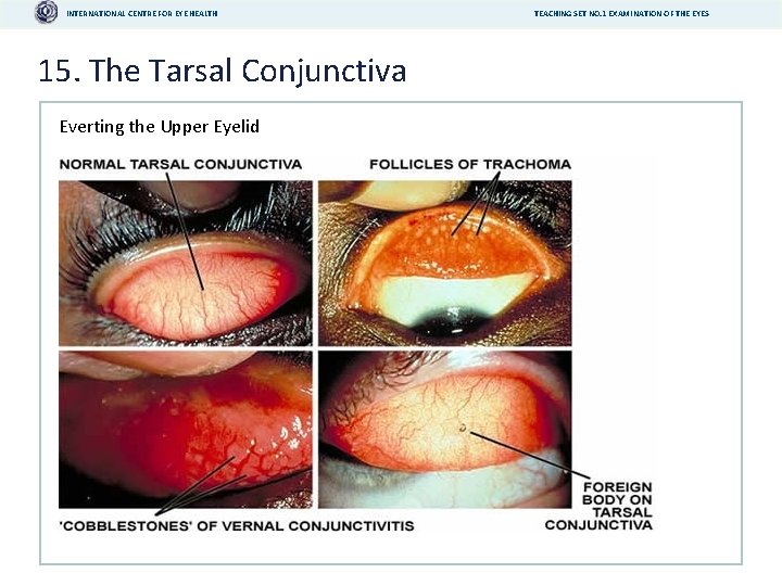 INTERNATIONAL CENTRE FOR EYE HEALTH 15. The Tarsal Conjunctiva Everting the Upper Eyelid TEACHING