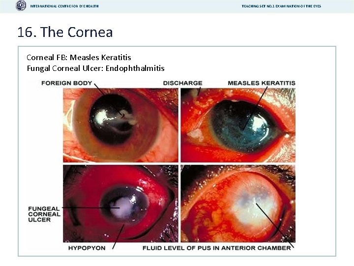 INTERNATIONAL CENTRE FOR EYE HEALTH 16. The Corneal FB: Measles Keratitis Fungal Corneal Ulcer: