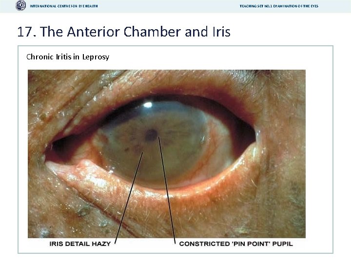 INTERNATIONAL CENTRE FOR EYE HEALTH 17. The Anterior Chamber and Iris Chronic Iritis in