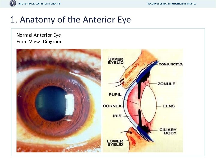 INTERNATIONAL CENTRE FOR EYE HEALTH 1. Anatomy of the Anterior Eye Normal Anterior Eye