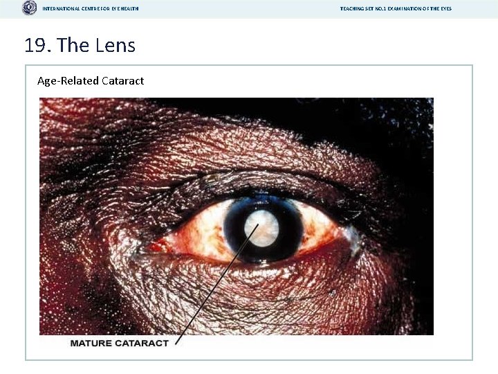 INTERNATIONAL CENTRE FOR EYE HEALTH 19. The Lens Age-Related Cataract TEACHING SET NO. 1